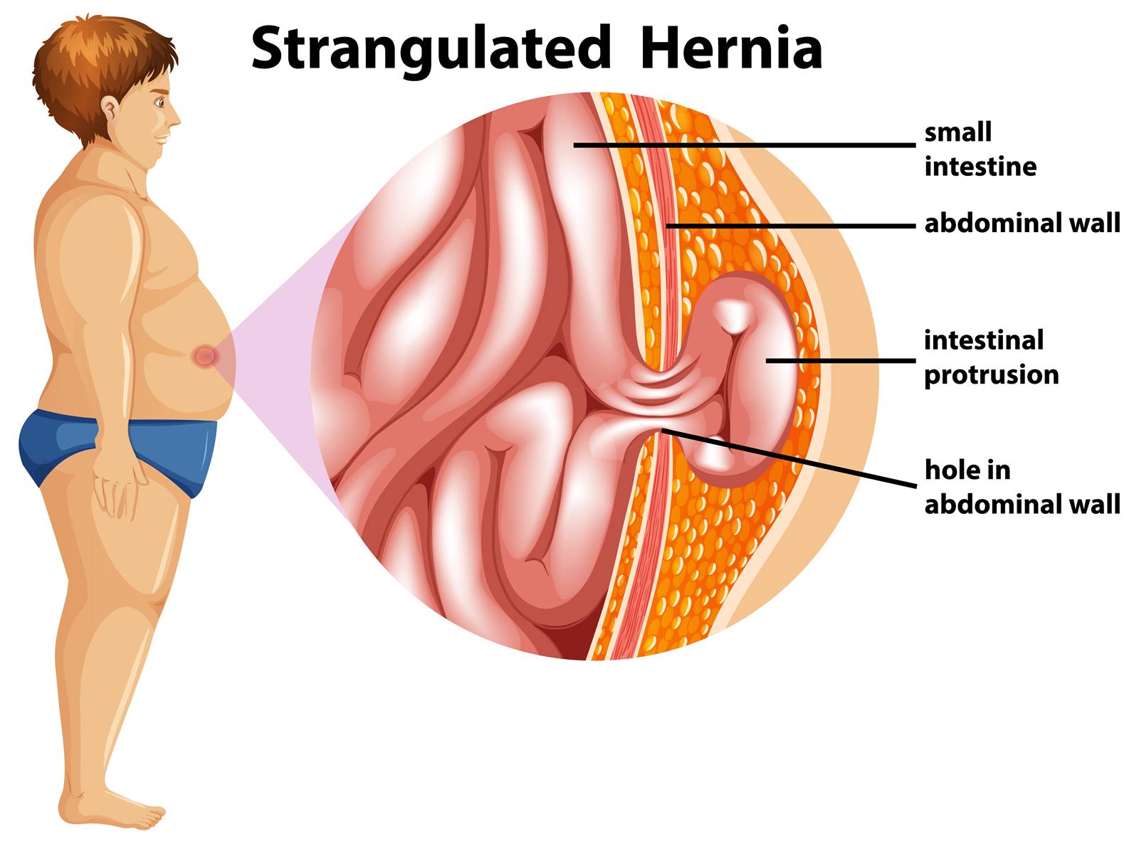 Best Hernia Surgeon in Santacruz Best Hernia Surgeon in Santacruz